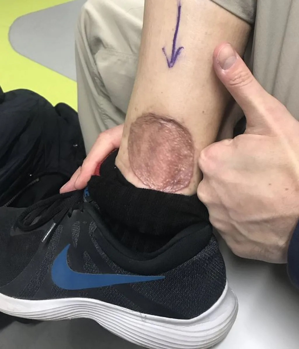 Hematoma